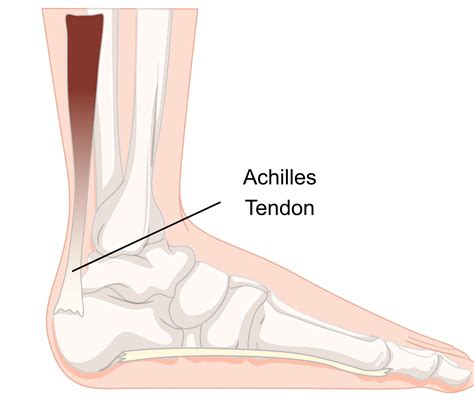 Achilles foot and ankle - Achilles tendon enthesopathy is pain where the Achilles tendon attaches to the back of the heel bone. People typically feel pain at the back of the heel when walking. Diagnosis includes an examination of the tendon and sometimes x-ray. Stretching, night splints, and heel lifts may help. (See also Overview of Foot Problems .)